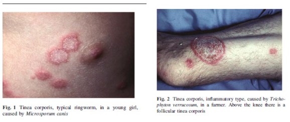 Understanding Ringworm (Dermatophytosis)