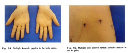 Punctate palmoplantar keratoderma (PPK)