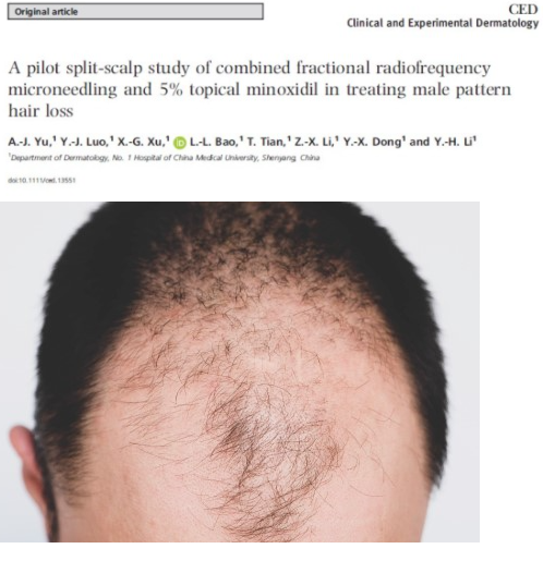 This study involves 19 Chinese men diagnosed with male pattern baldness. The entire scalp was sprayed twice daily with 1ml of 5% Minoxidil.